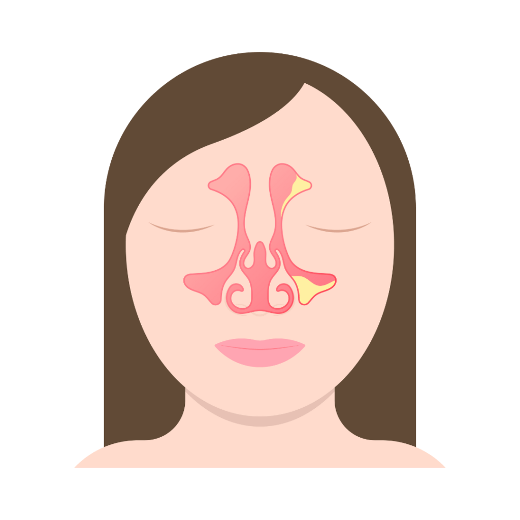 Inflamed Sinus